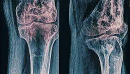 Estudio PRORADIUM: Evaluación de biomarcadores del metabolismo óseo y supervivencia en pacientes con cáncer de próstata metastásico.