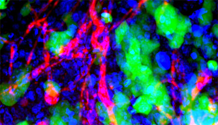 Nueva plataforma de cribado de fármacos frente a la metástasis cerebral