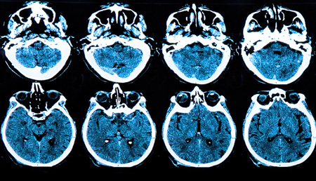 La inteligencia artificial y la genómica se unen para determinar la esperanza de vida de pacientes con tumor cerebral