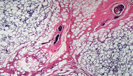 Análisis fosfoproteómico del cáncer de mama neoadyuvante indica que el aumento de la sensibilidad al paclitaxel se debe a CDK4 y a la filamina A
