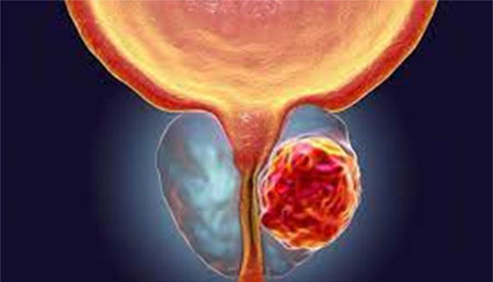 Impacto de eventos tumorales concomitantes en la evolución del cáncer de próstata en portadores de BRCA2.