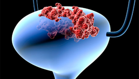 Análisis integral de la respuesta inmunitaria en pacientes con cáncer de vejiga no músculo-invasivo (NIMIBC). 