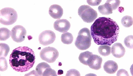 Identifican más de 500 alteraciones en la función del genoma específicas de la leucemia linfática crónica